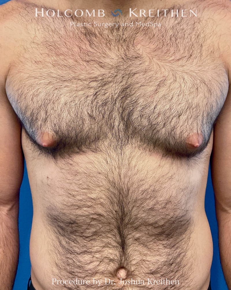 Gynecomastia Before & After Gallery - Patient 582395 - Image 1