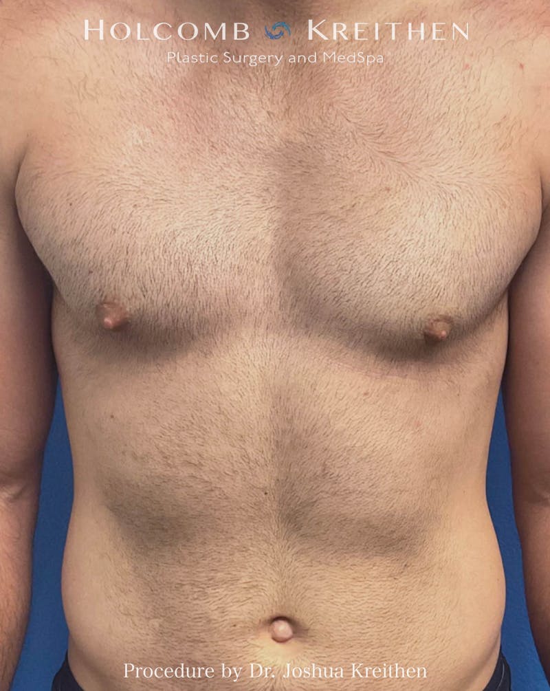 Gynecomastia Before & After Gallery - Patient 582395 - Image 2