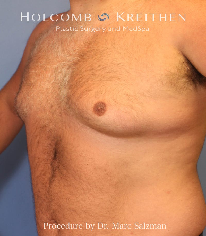 Gynecomastia Before & After Gallery - Patient 281144 - Image 1