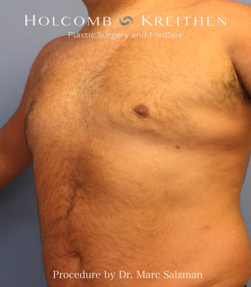 Gynecomastia Before & After Gallery - Patient 281144 - Image 2