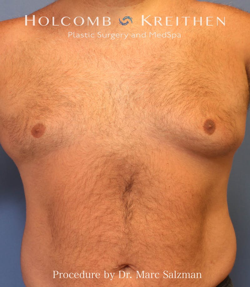 Gynecomastia Before & After Gallery - Patient 281144 - Image 3