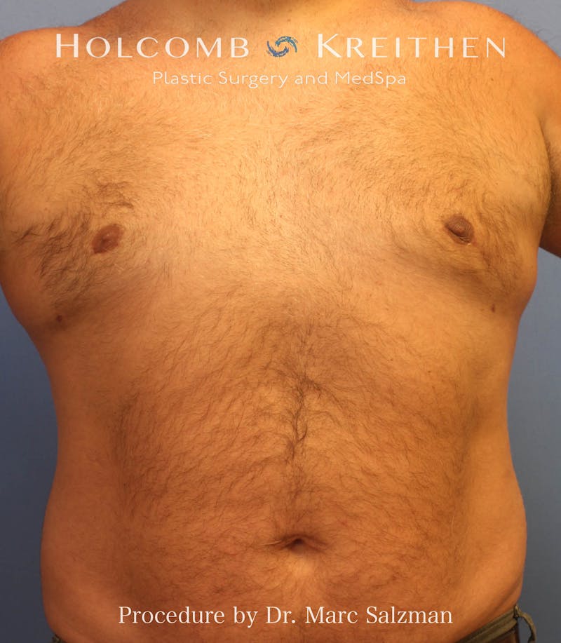 Gynecomastia Before & After Gallery - Patient 281144 - Image 4