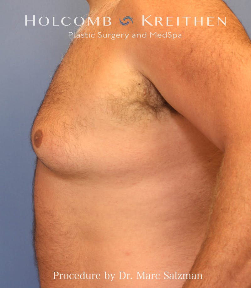 Gynecomastia Before & After Gallery - Patient 281144 - Image 5