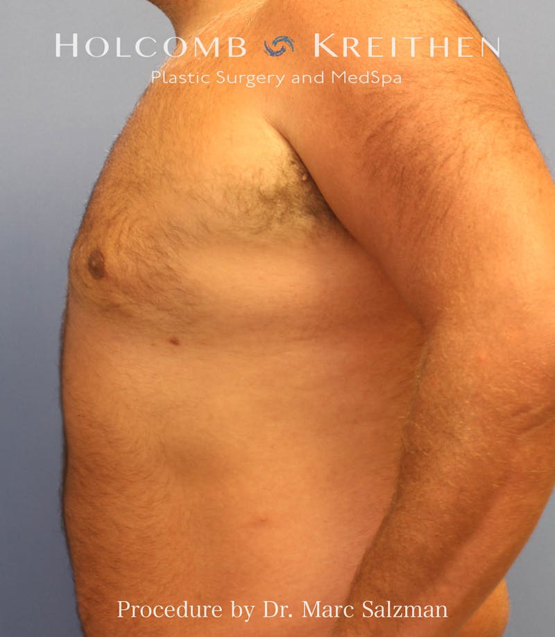 Gynecomastia Before & After Gallery - Patient 281144 - Image 6