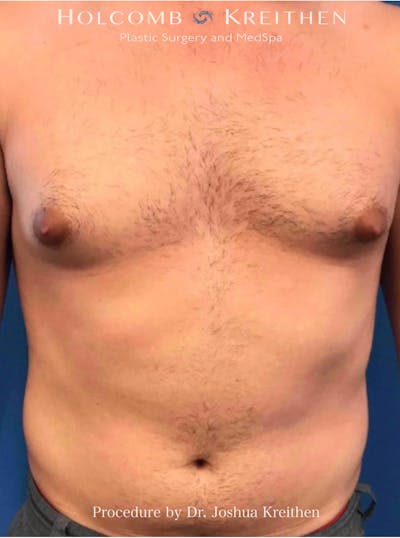 Gynecomastia Before & After Gallery - Patient 253810 - Image 1