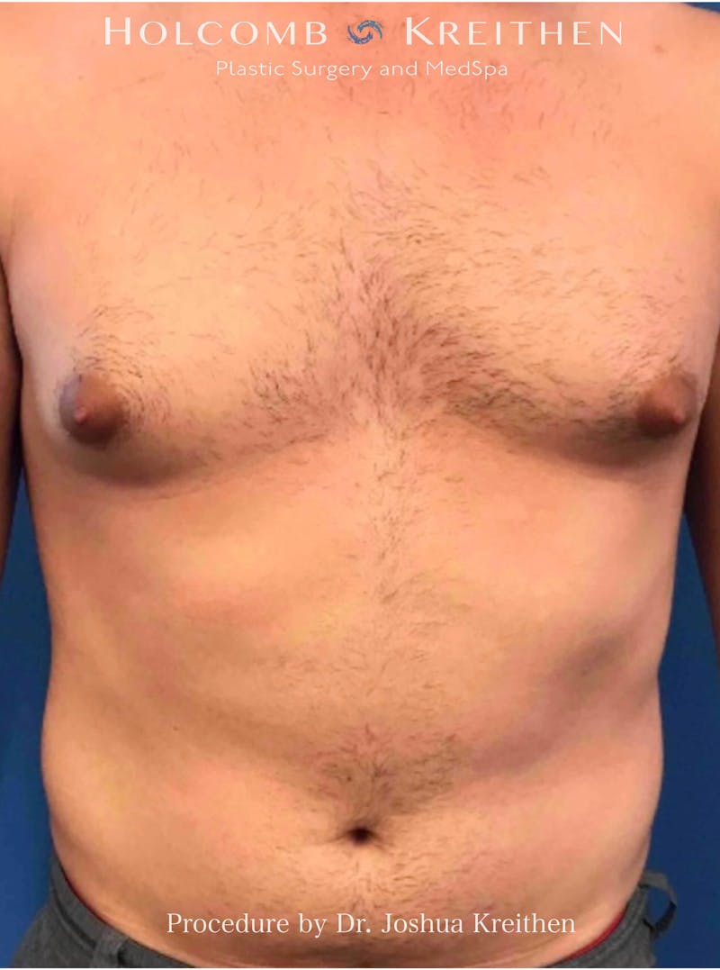 Gynecomastia Before & After Gallery - Patient 253810 - Image 1