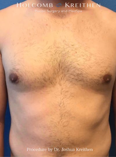 Gynecomastia Before & After Gallery - Patient 253810 - Image 2