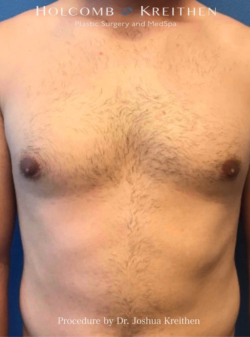Gynecomastia Before & After Gallery - Patient 253810 - Image 2