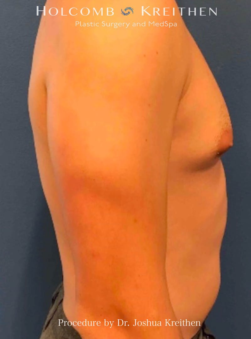 Gynecomastia Before & After Gallery - Patient 253810 - Image 3