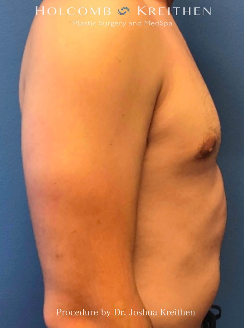 Gynecomastia Before & After Gallery - Patient 253810 - Image 4