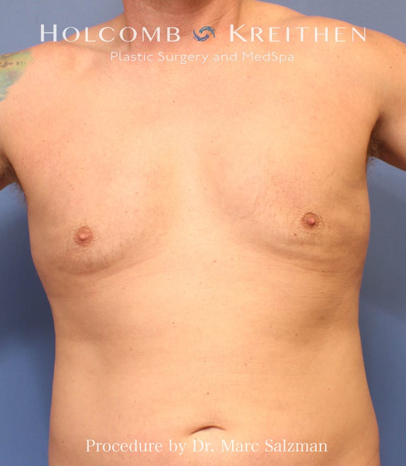 Gynecomastia Before & After Gallery - Patient 289694 - Image 1