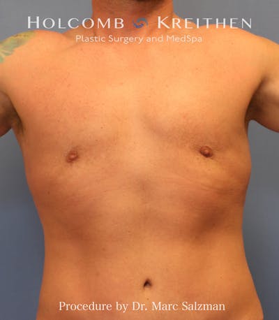 Gynecomastia Before & After Gallery - Patient 289694 - Image 2