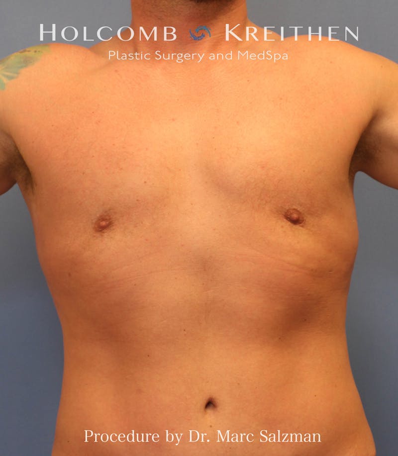 Gynecomastia Before & After Gallery - Patient 289694 - Image 2