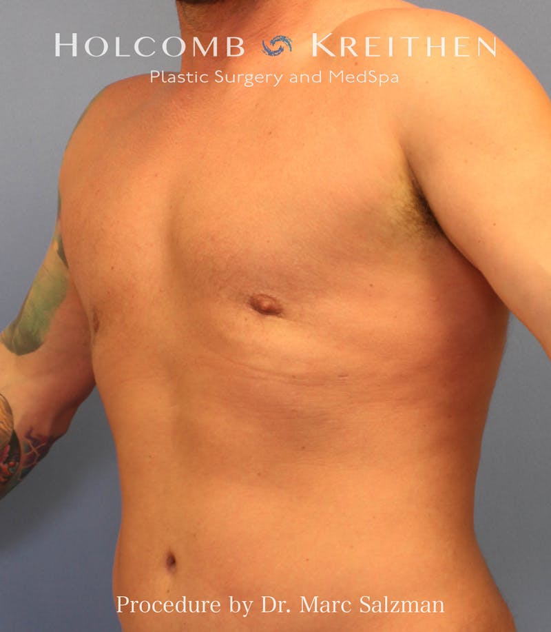 Gynecomastia Before & After Gallery - Patient 289694 - Image 4