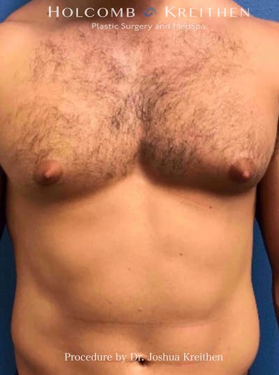 Gynecomastia Before & After Gallery - Patient 939307 - Image 1