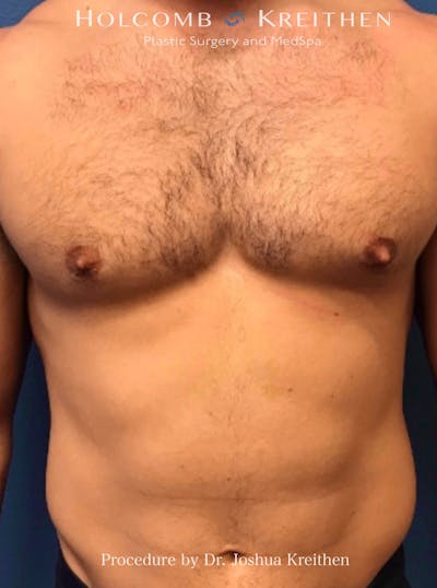 Gynecomastia Before & After Gallery - Patient 939307 - Image 2