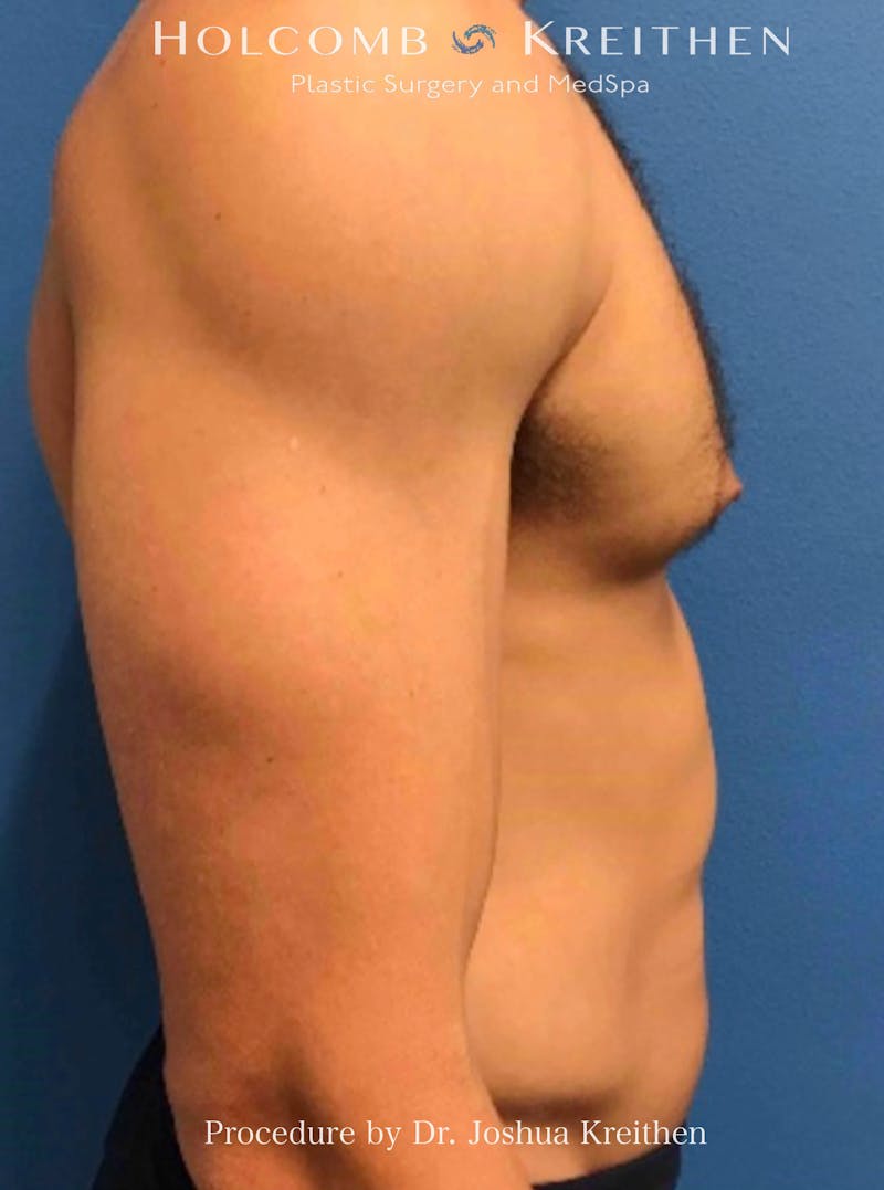 Gynecomastia Before & After Gallery - Patient 939307 - Image 3