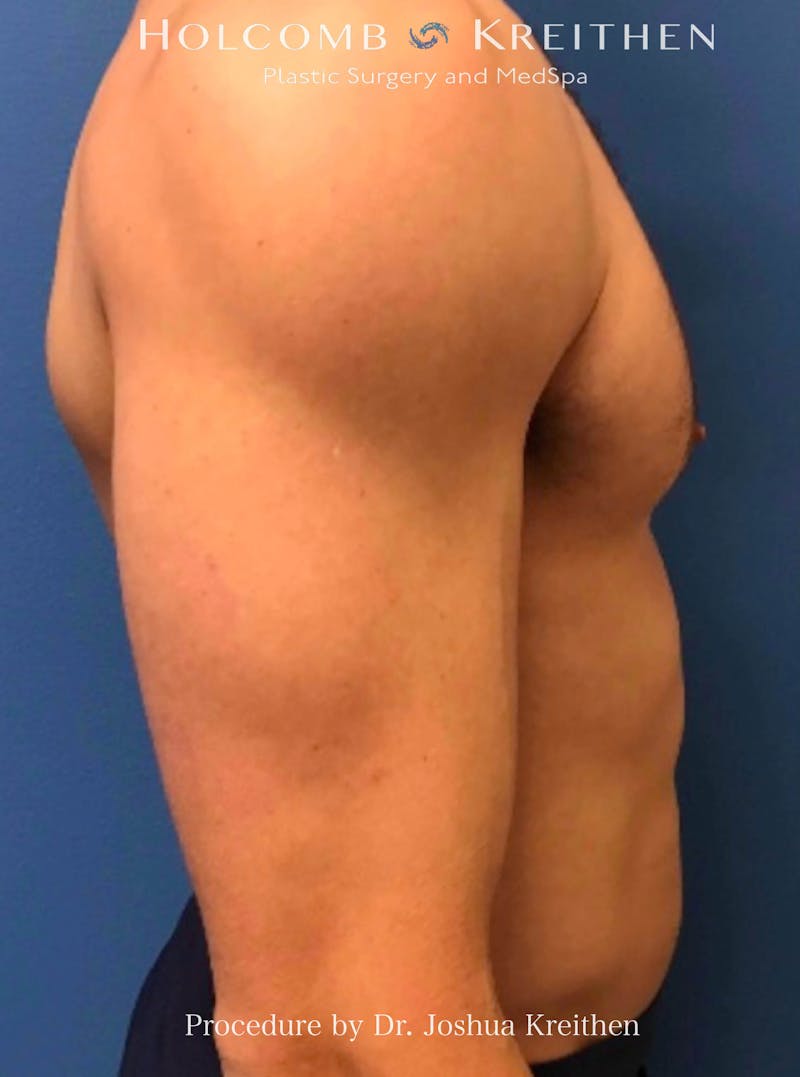 Gynecomastia Before & After Gallery - Patient 939307 - Image 4
