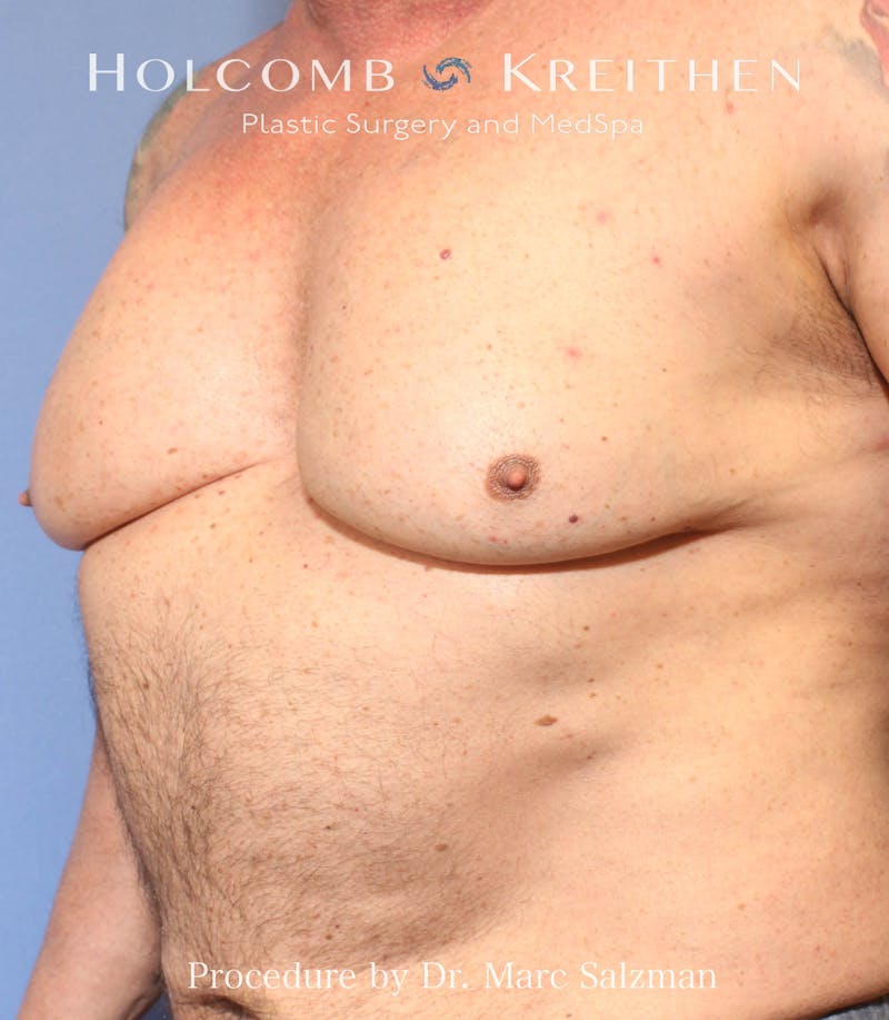 Gynecomastia Before & After Gallery - Patient 913077 - Image 1