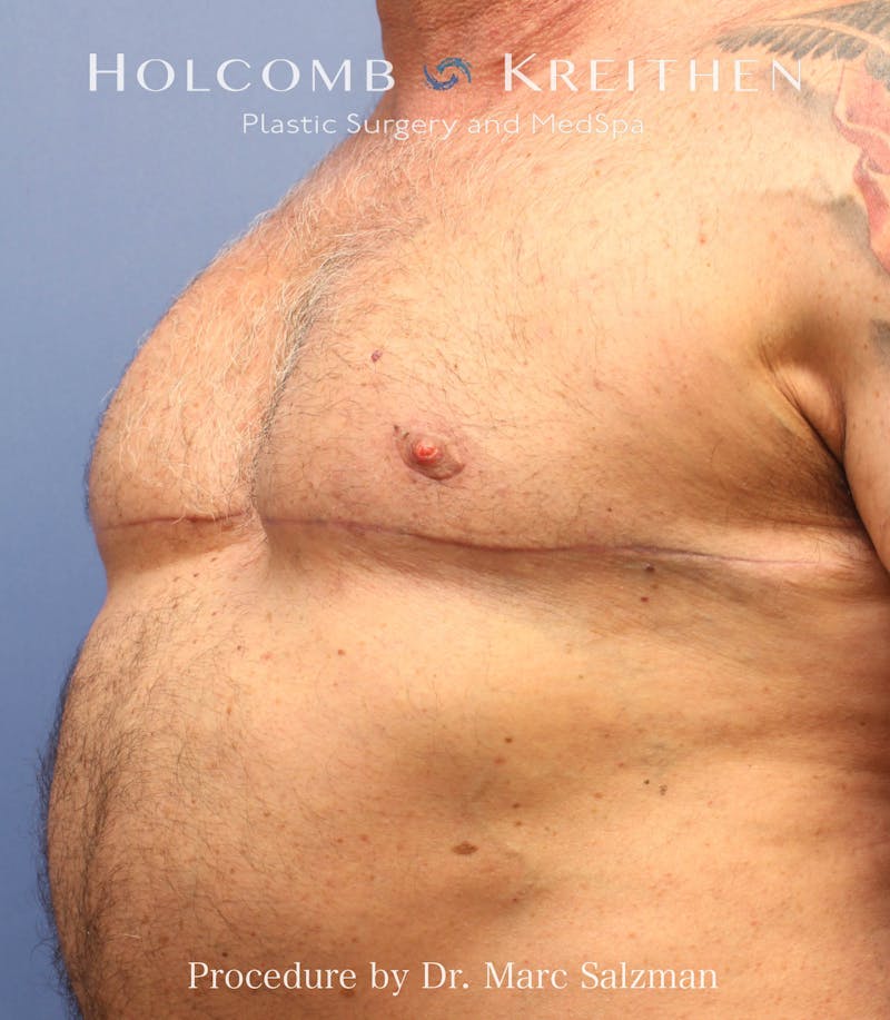 Gynecomastia Before & After Gallery - Patient 913077 - Image 2