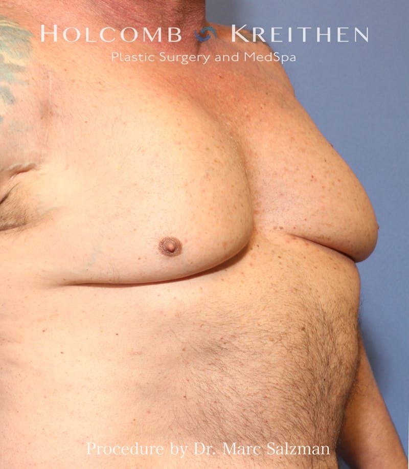 Gynecomastia Before & After Gallery - Patient 913077 - Image 3