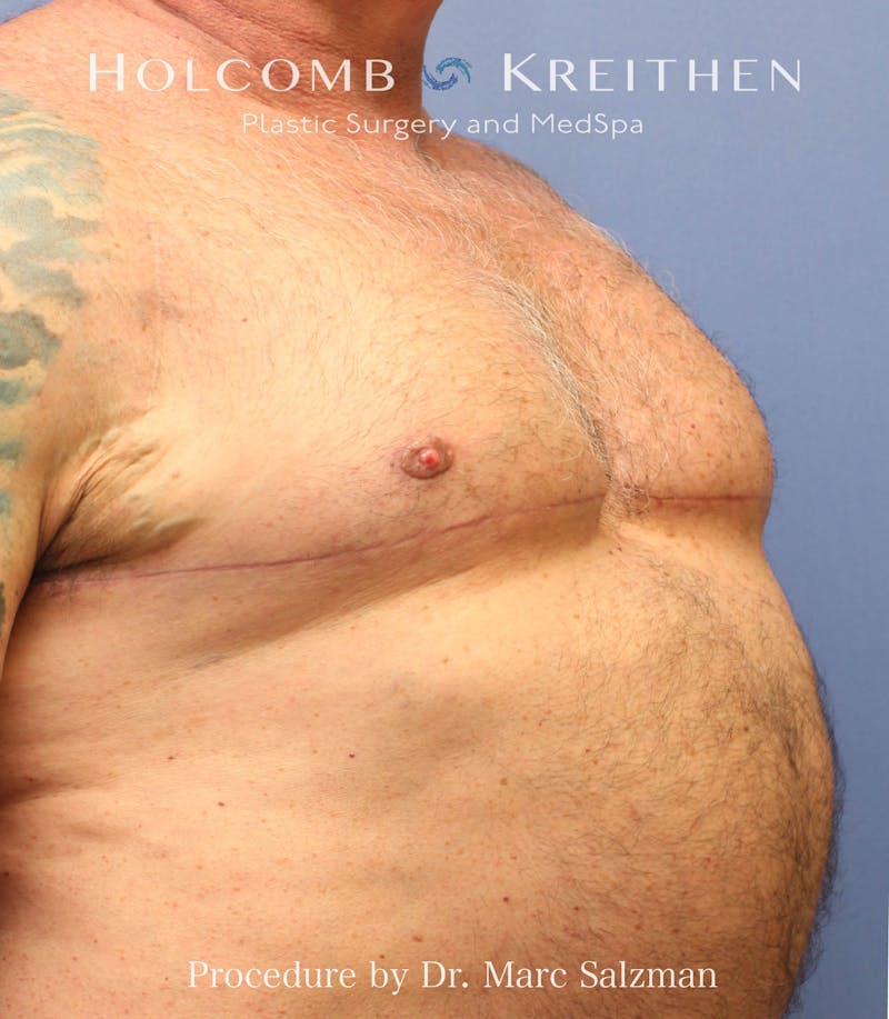 Gynecomastia Before & After Gallery - Patient 913077 - Image 4