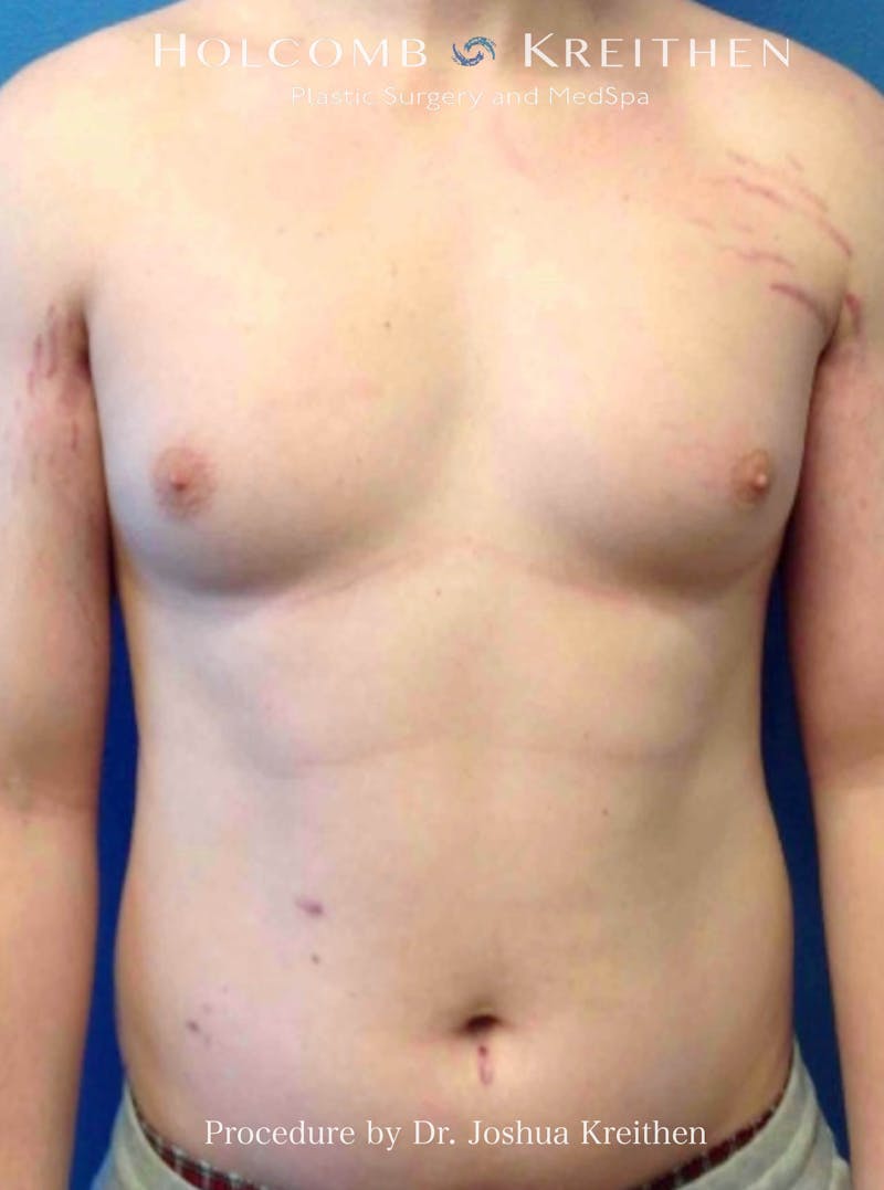 Gynecomastia Before & After Gallery - Patient 151886 - Image 1