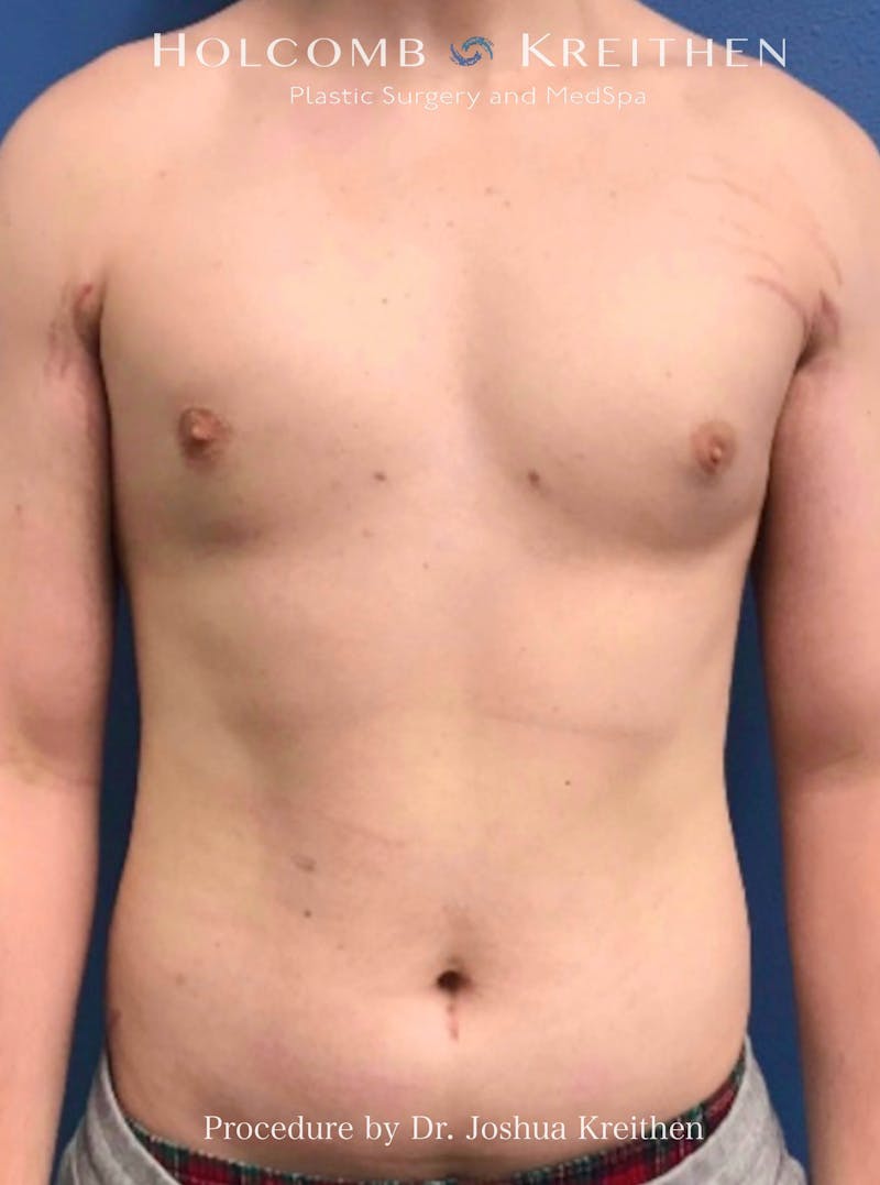 Gynecomastia Before & After Gallery - Patient 151886 - Image 2