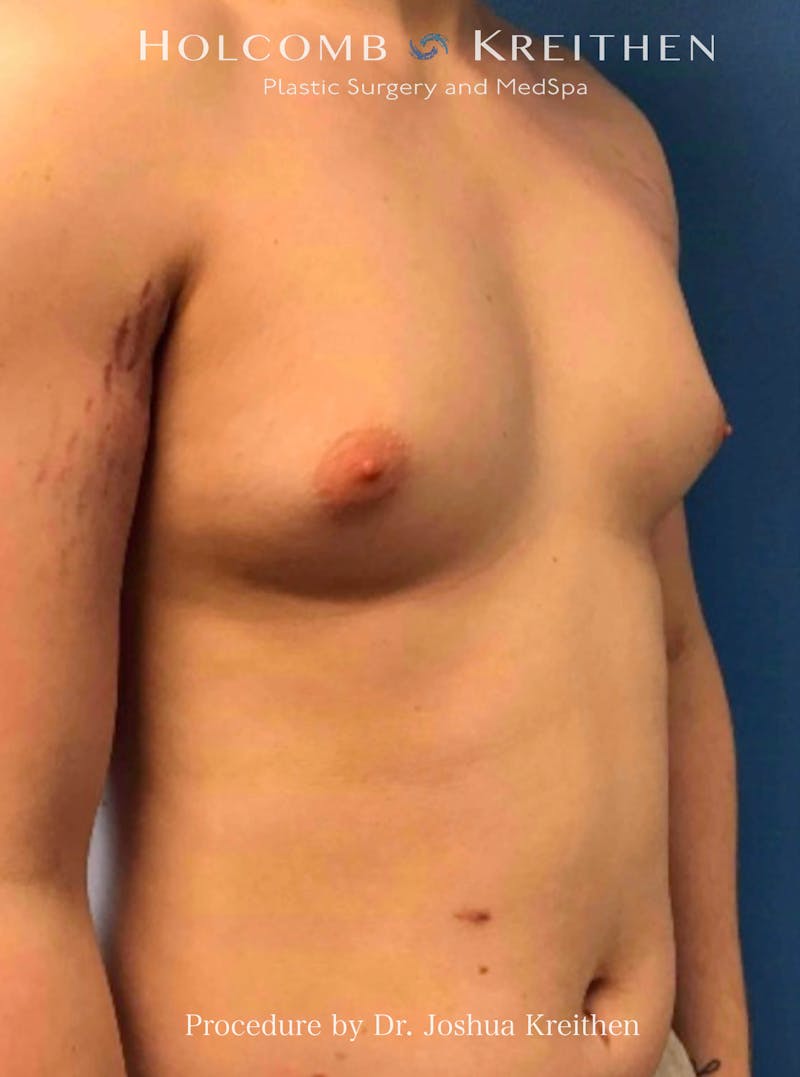 Gynecomastia Before & After Gallery - Patient 151886 - Image 3