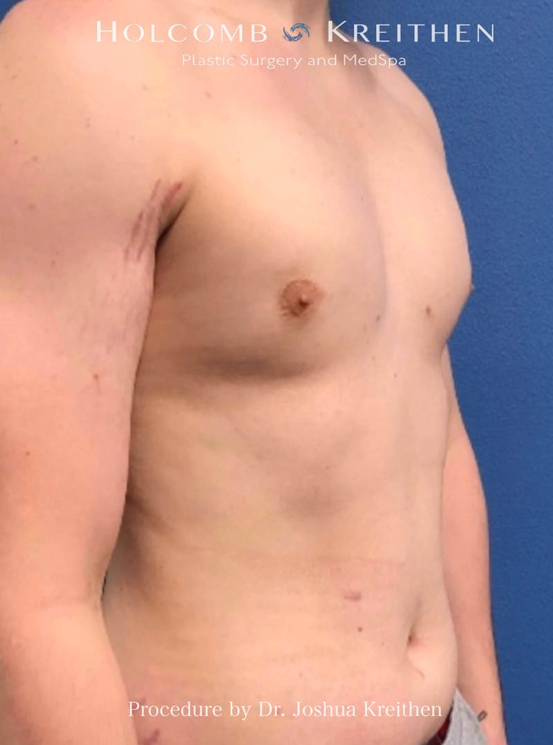 Gynecomastia Before & After Gallery - Patient 151886 - Image 4