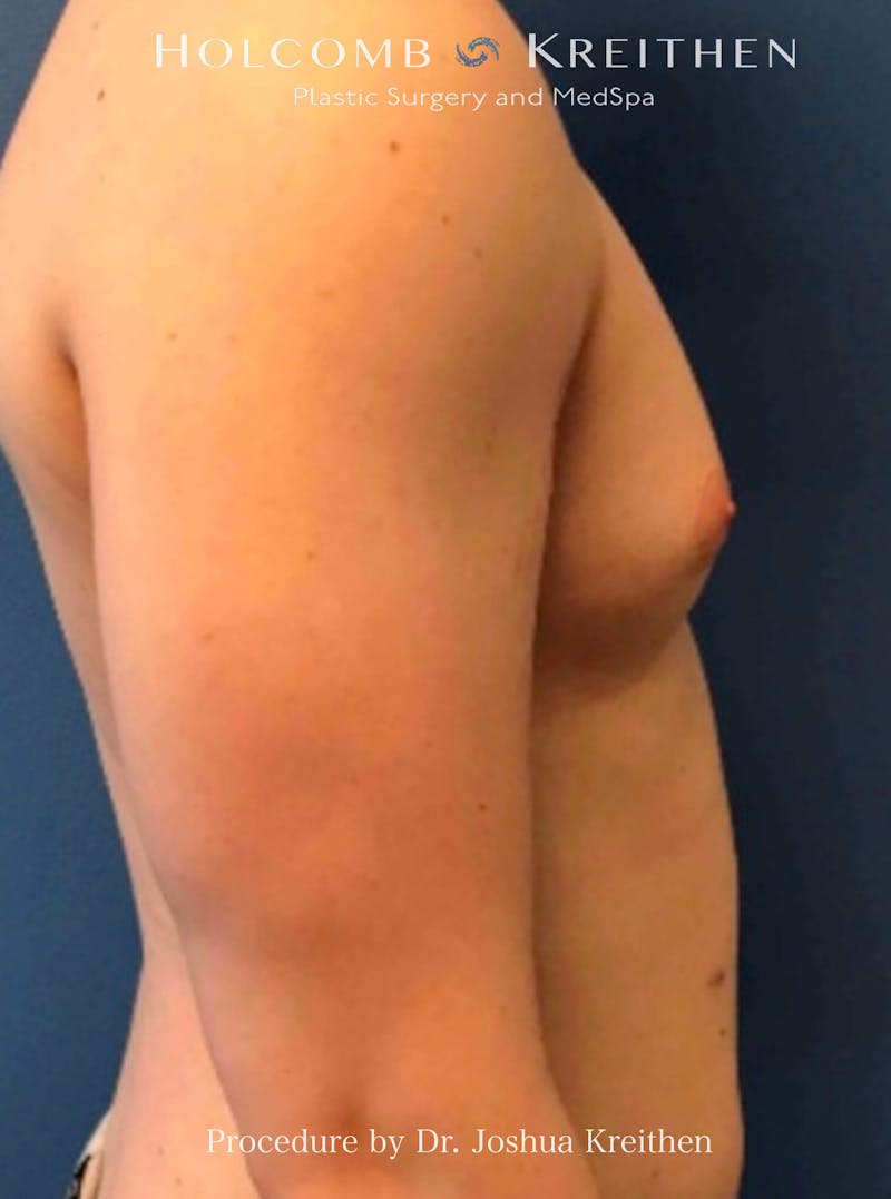 Gynecomastia Before & After Gallery - Patient 151886 - Image 5