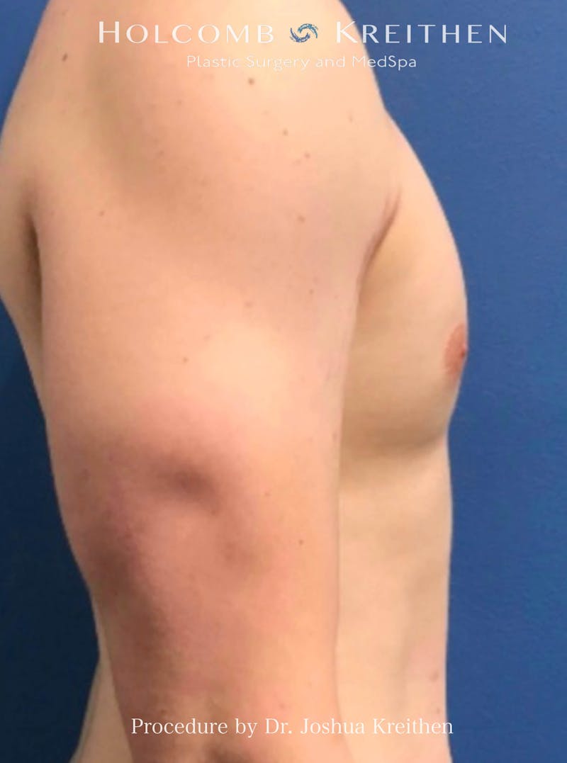 Gynecomastia Before & After Gallery - Patient 151886 - Image 6