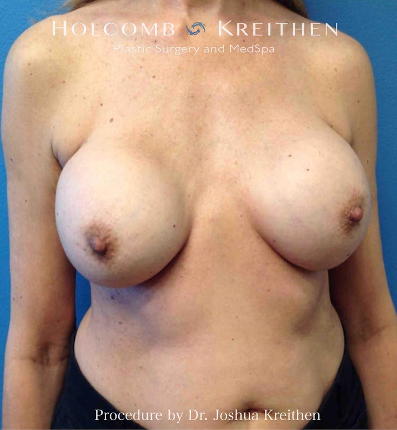 Implant Exchange Before & After Gallery - Patient 475977 - Image 1