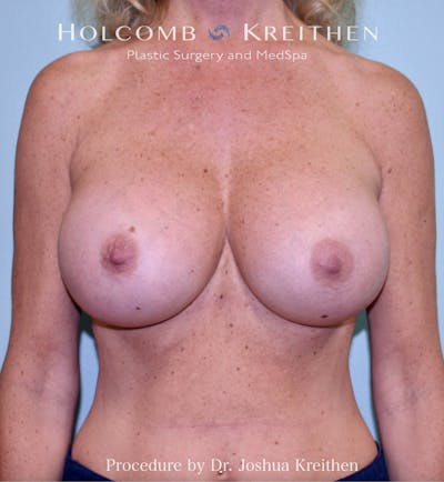 Implant Exchange Before & After Gallery - Patient 384484 - Image 2
