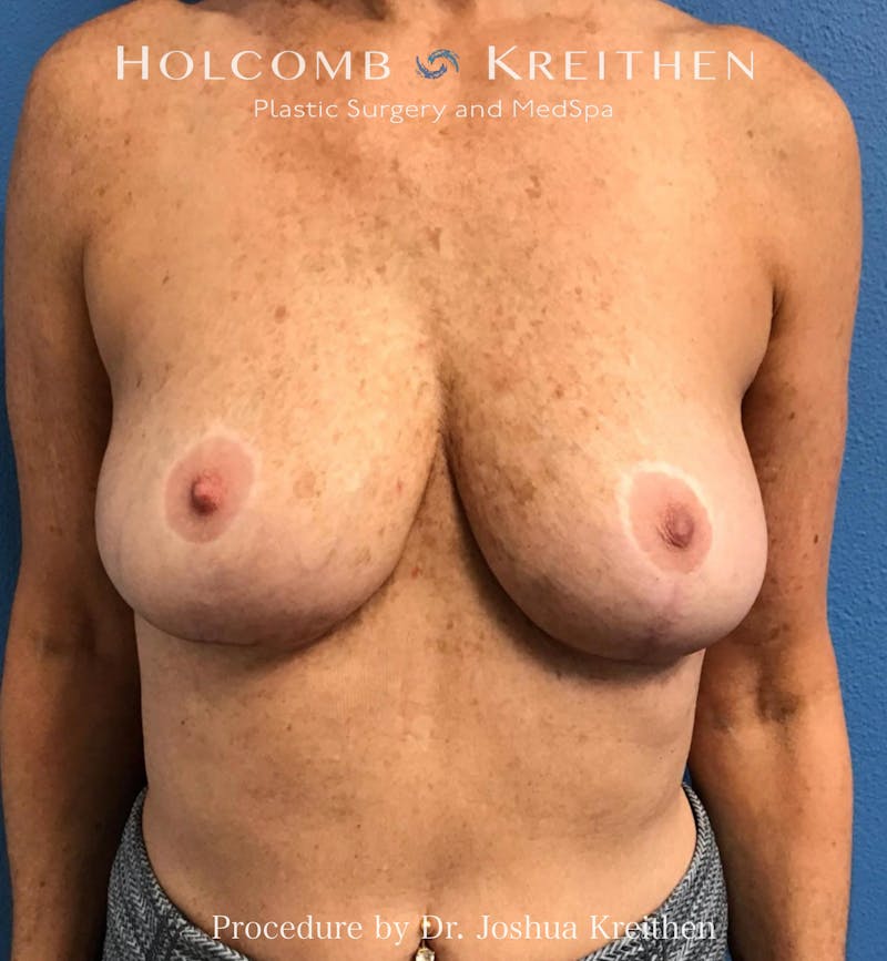 Implant Exchange Before & After Gallery - Patient 195847 - Image 2