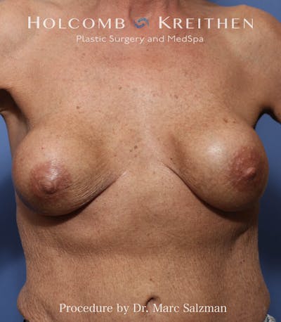 Implant Exchange Before & After Gallery - Patient 138167 - Image 1