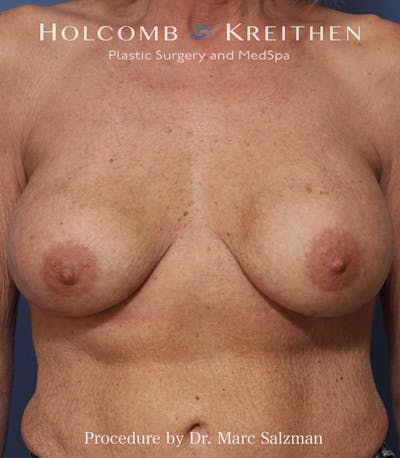 Implant Exchange Before & After Gallery - Patient 138167 - Image 2