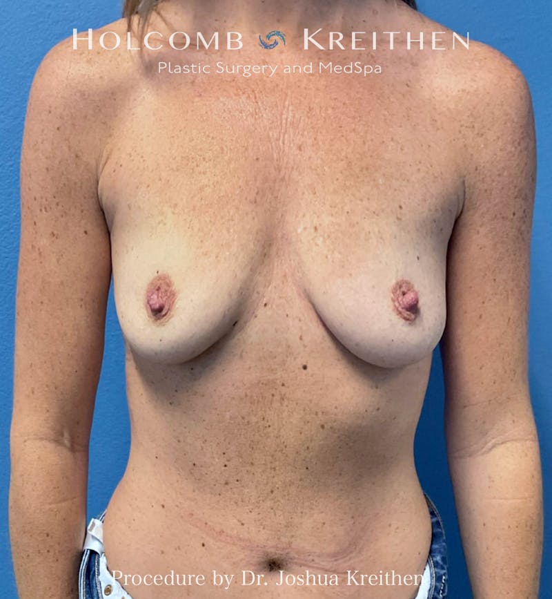 Motiva Breast Implants Before & After Gallery - Patient 379357 - Image 1