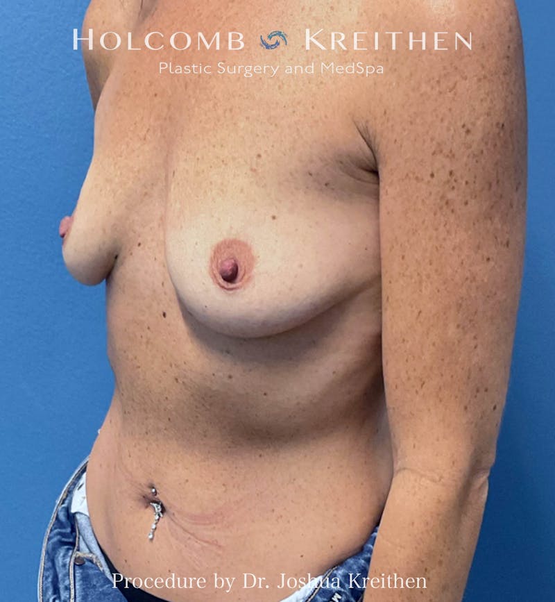 Motiva Breast Implants Before & After Gallery - Patient 379357 - Image 3