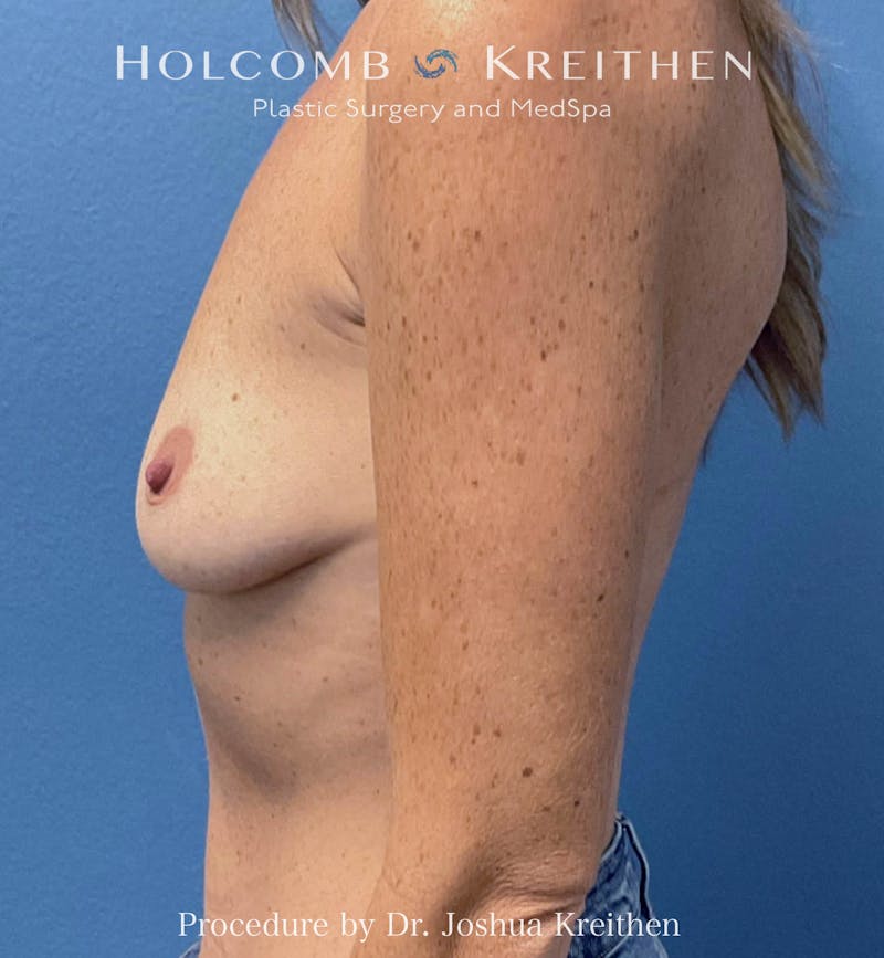 Motiva Breast Implants Before & After Gallery - Patient 379357 - Image 5