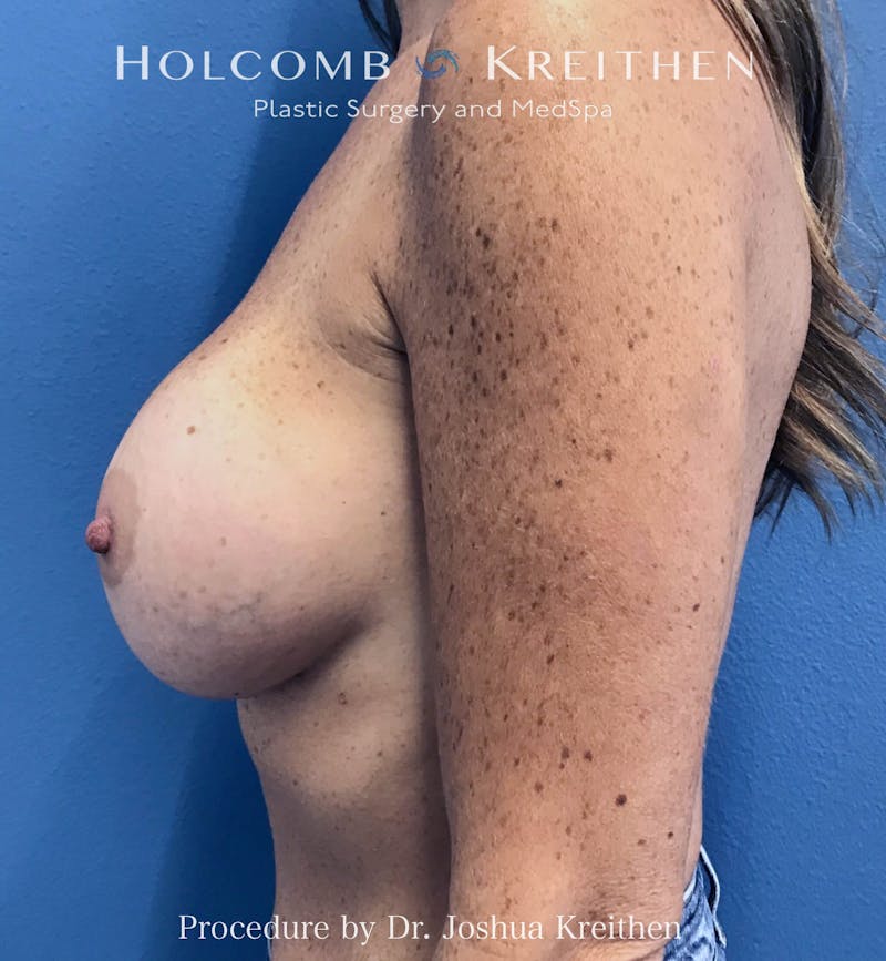 Motiva Breast Implants Before & After Gallery - Patient 379357 - Image 6