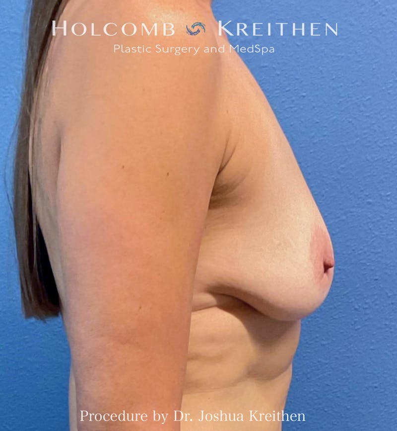 Motiva Breast Implants Before & After Gallery - Patient 208283 - Image 3