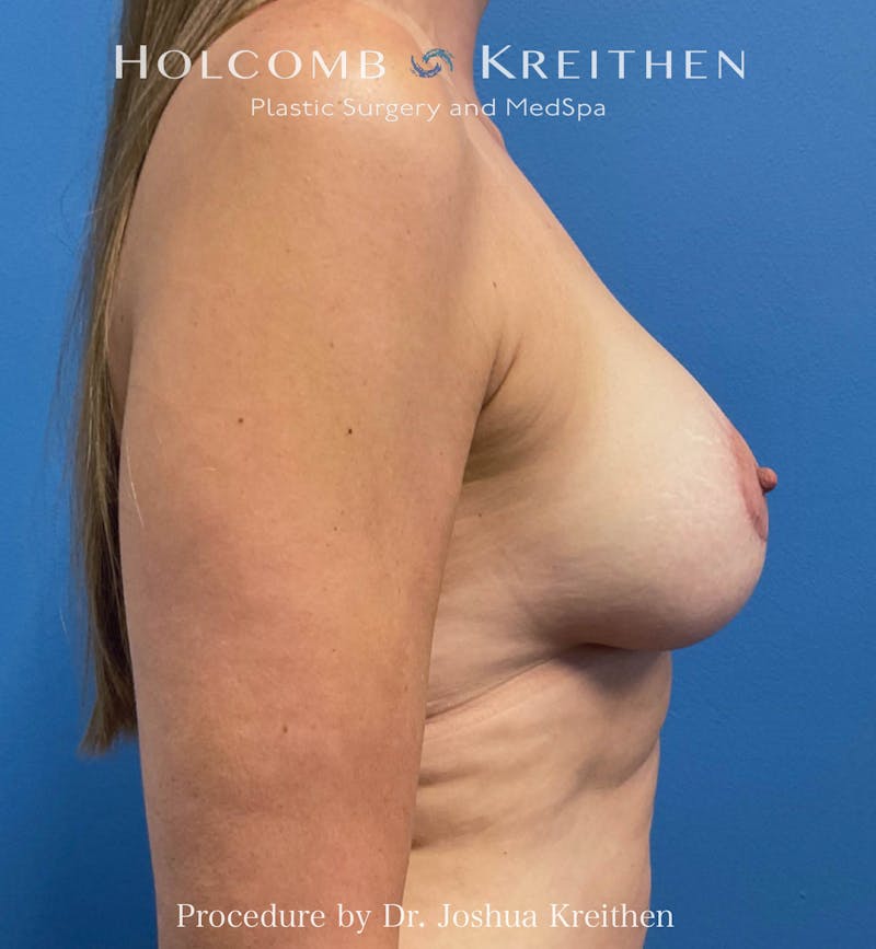 Motiva Breast Implants Before & After Gallery - Patient 208283 - Image 4