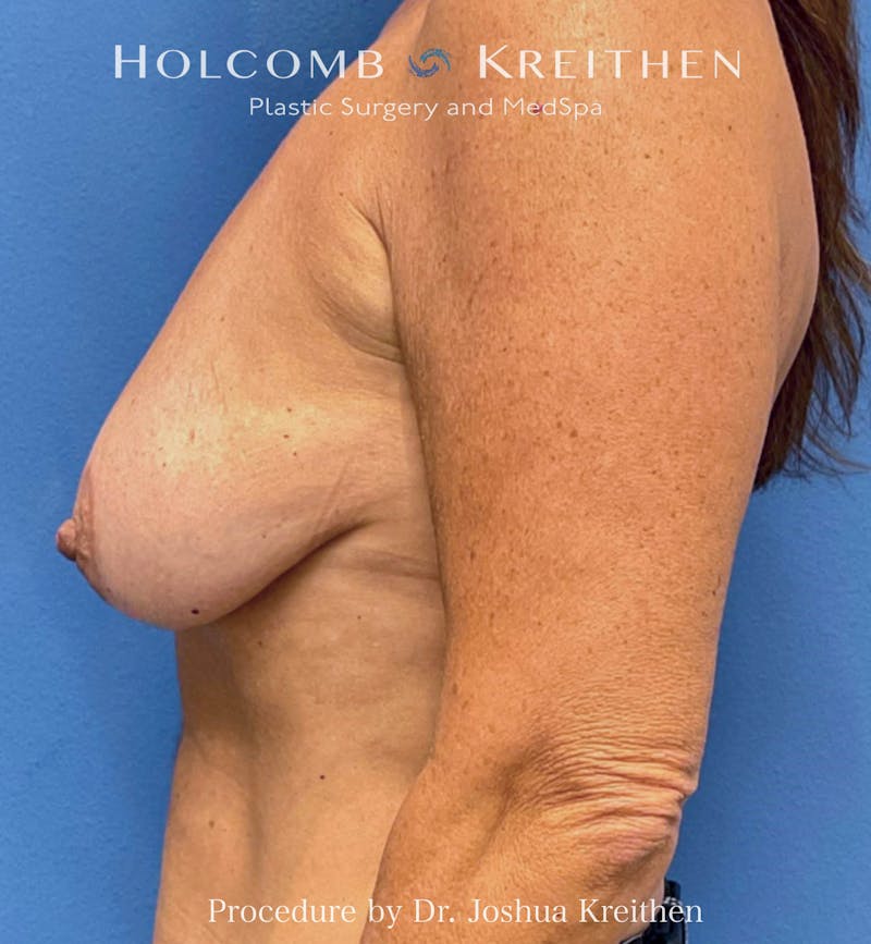 Breast Augmentation & Lift Before & After Gallery - Patient 132766 - Image 3