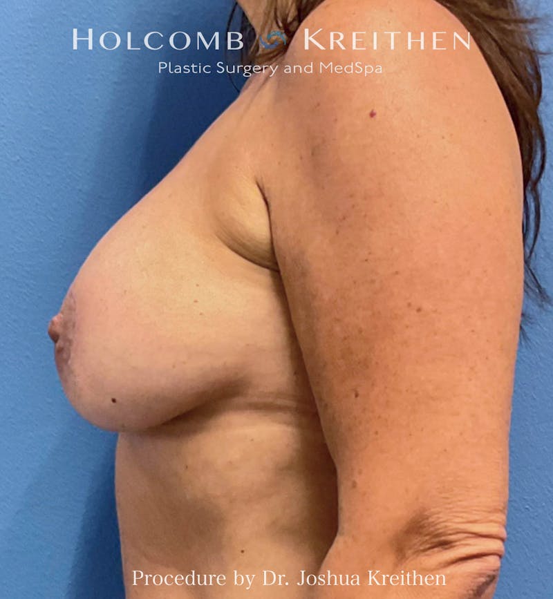 Breast Augmentation & Lift Before & After Gallery - Patient 132766 - Image 4