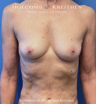 Motiva Breast Implants Before & After Gallery - Patient 300098 - Image 1