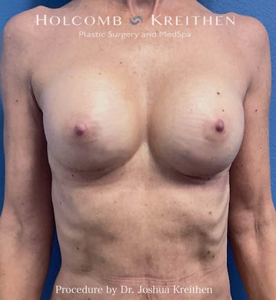 Motiva Breast Implants Before & After Gallery - Patient 300098 - Image 2