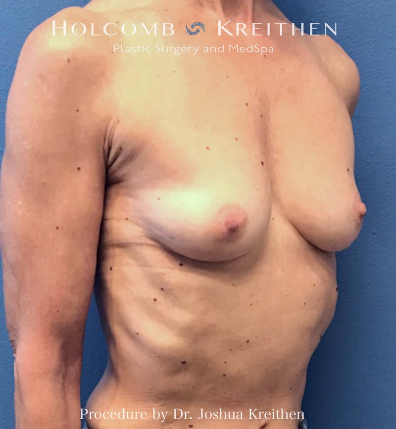 Motiva Breast Implants Before & After Gallery - Patient 300098 - Image 3
