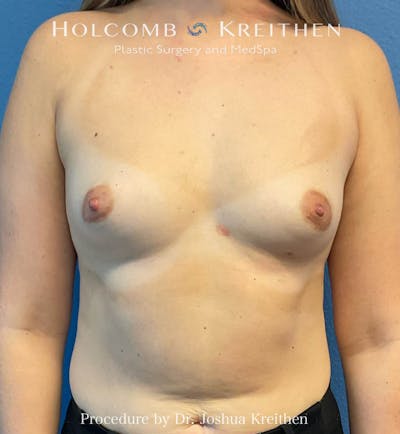 Motiva Breast Implants Before & After Gallery - Patient 298736 - Image 1