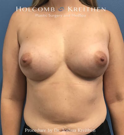 Motiva Breast Implants Before & After Gallery - Patient 298736 - Image 2